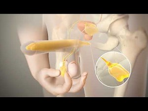 Penile Implants for Erectile Dysfunction - Dr. Sanjay Razdan
