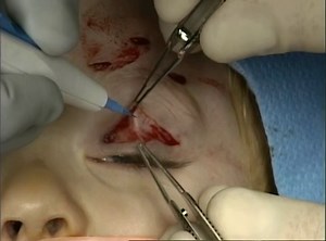 Fascia frontalis sling