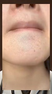 Use this japanese rice face mask for a skin without blemishes or pimples #ricemask #facemask #blemishes #pimples #naturalremedy | Doctor William