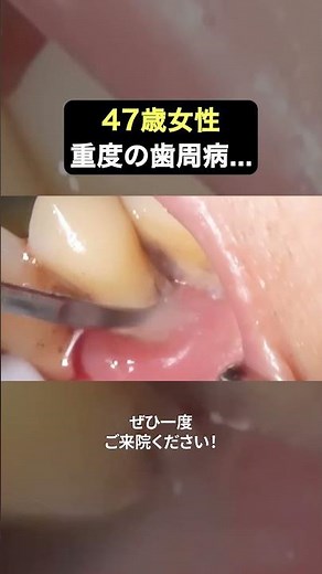 Tartar removal for severe periodontal disease‼️#TheWhiteDentalClinic #dentist #tartarremoval #per...