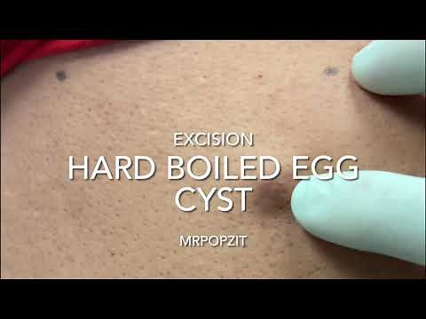 Hard boiled egg cyst. Dry cyst pop. Looks just like boiled egg. Cyst excision and closure. MrPopZit