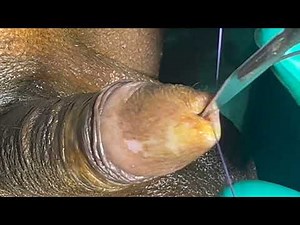 Buccal mucosa graft meatoplasty