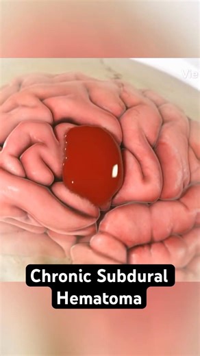 The Brain Bleed You Don’t Feel