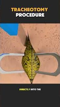 Tracheotomy Surgery Explained Step by Step | Tracheostomy #Tracheotomy #TracheostomyProcedure