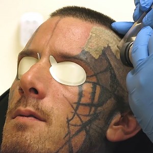 This face tattoo removal is so satisfying to watch 🎯 GO! Tattoo Removal | LADbible