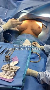 Breast Augmentation: See How Markings Are Placed for a Crescent Lift