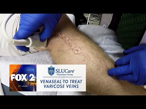 How The New VenaSeal Varicose Vein Treatment Works - SLUCare Health Watch