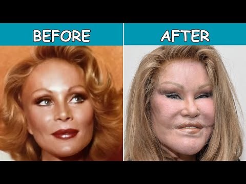 50+ Celebrity Plastic Surgery Disasters Before and After
