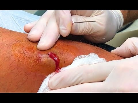 Caveman's Cellulitis! Warning: Pus, Popping & Pinching