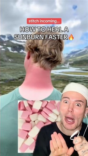 HOW TO HEAL A SUNBURN FASTER!🔥 #sunburn #skincaretips #skincareroutine #summershorts