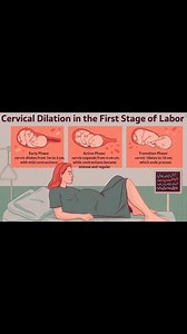 WHAT ARE THE STAGES OF THE FIRST STAGE OF LABOR? The first stage of labor has three phases: ✅ latent (early) labor, ✅active labor, and ✅transition. ✅ Latent phase (early labor) 🔴Cervical change: The cervix thins out and dilates from 0 to about 4-6 cm. 🔴Contractions: They are typically mild, irregular, or mild but become progressively stronger and more rhythmic. 🔴Duration: This is the longest phase, and it can last for hours or even days, especially in a first pregnancy. 🔴What to do: Stay at 