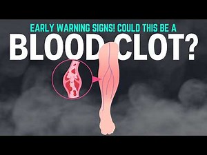 Early Signs of Blood Clots: What You Need to Know