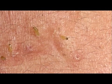 🔥 Pimple Popping 2020| Blackheads extraction new| Blackheads removal| Acne removal|Acne treatment