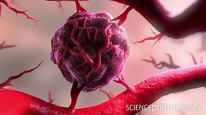 Animation of a tumour attracting new blood vessels to grow towards it, a process known as angiogenesis. Initially, a tumour is a small ball of cancerous cells, which divide rapidly. A tumour can only grow to a certain size without its own blood supply, however, and without its own blood supply, it generally remains benign. To increase its supply of oxygen and nutrients, and to help remove its waste, a tumour can secrete growth factors that prompt the development of new vessels. This angiogenesis