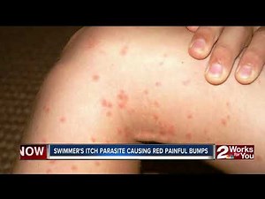 HN2U: Swimmer's itch parasite causing red painful bumps
