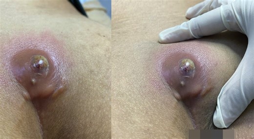 Large Pilonidal Cyst Incision and Drainage