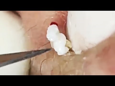 Deep blackhead extraction Cystic acne & pimple popping #51