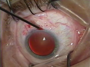 2000s VHS • Eye Surgery 60 FPS