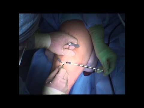 ACL Surgery - First Incision