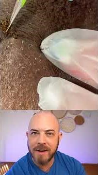 Derm reacts to INSANE ingrown hair extraction! #dermreacts #doctorreacts #ingrownhair