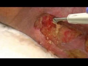 Demonstration: Yellow slough removed via Qoustic Wound Therapy System