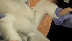 Hip S​pica Casting Technique for the Management of DDH