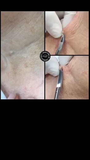 Dr Pimple Popper Reveals Skin Tag Removal Technique