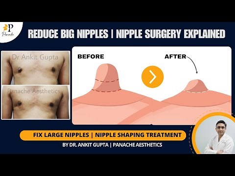 Male Nipple Reduction Procedure FAQs | Before After Results | Everything You Need to Know