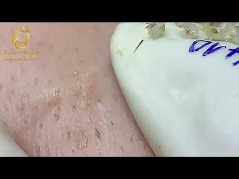 Blackheads and Whiteheads extraction (410) | Loan Nguyen