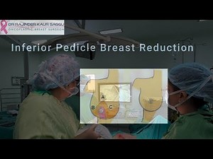 Breast Reduction I Wise Pattern Inferior pedicle Reduction Mammoplasty | Dr Rajinder Kaur Saggu