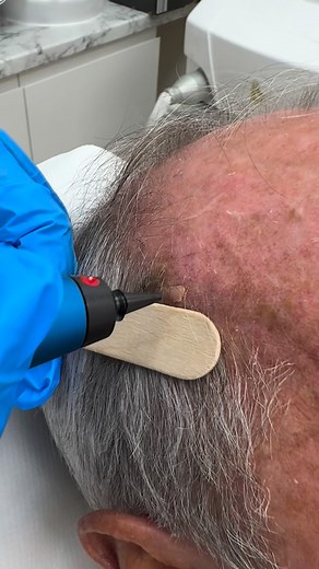 #cryosurgery #skincare #skintagremoval #skintagsolution #skin #leeds | Allure Hair Skin Laser Treatment