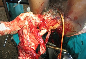 DESTRUCTIVE DELIVERY / INTRAUTERINE FETAL DEATH