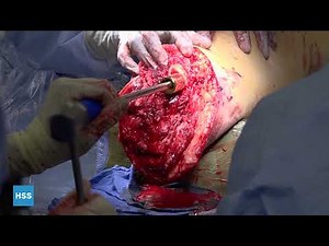 Osseointegration of the Tibia After Primary Amputation - Live Surgery