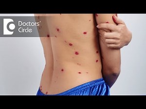 How to manage Chickenpox during pregnancy? - Dr. Sangeeta Gomes