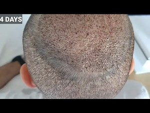 FUE Hair Transplant Timeline | Month 1 to 6 | Before & After