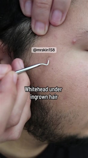 Satisfying Whitehead Popping Techniques