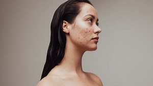 How to Treat Every Type of Adult Acne at Home
