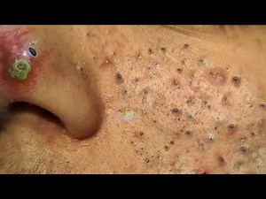 Blackhead Removal With Sac Dep Spa @100074701
