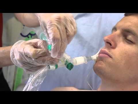 Intersurgical TrachSeal Geschlossene Absaugung