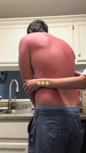 Understanding Sunburns: Tips and Prevention Techniques