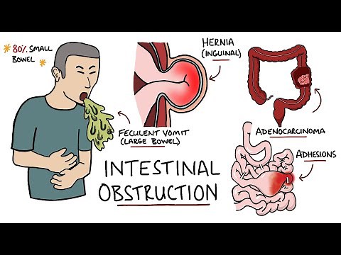 Intestinal Obstruction - Small Bowel Obstruction vs Large Bowel Obstruction