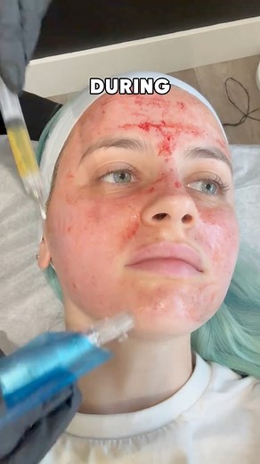 vampire facial for the WIN 🧛🏻‍♀️ #microneedling #prp #acnescars #skincare #glassskin #glowyskin #skincareroutine #beautytips #beauty #review #skincarereview #rosacea #skintreatment #clearskin #beautytreatment | Polder Express