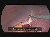 Laparoscopic Right Liver Resection • Video • MEDtube.net