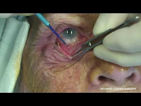 Entropion Repair with Modified LTS and Everting Sutures