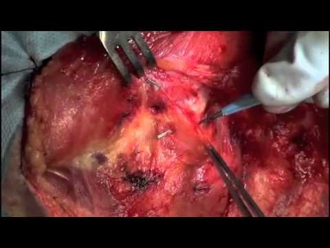 Modified Radical Neck Dissection Part I. Dr John M Chaplin, Auckland , New Zealand
