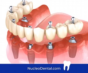 Full mouth rehabilitation is by no means a simple procedure. It requires expert care and proper precision. For this reason, it is necessary to choose a dentist who can give you exactly what you deserve. . Phone: 915 308 0101 nucleodental.com . #NucleoDental #dentalclinicnearme #dentaltourismmexico #dentalimplantsjuarez #bestdentalserviceintown #dentalservice #elpasotexas #CiudadJuárez | Nucleo Dental