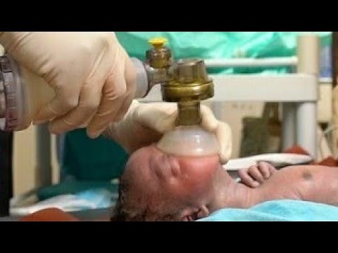 Neonatal Resuscitation-Helping a baby to breathe. An updated guidline by American paediatric Associa
