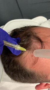 Prp hair injections