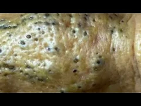 Blackhead Fields & Spreading Blackheads