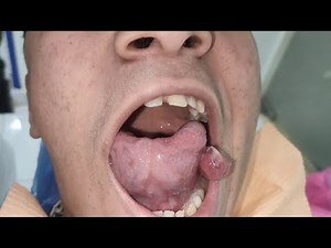 Pyogenic granuloma and labial frenectomy. The use of electrocautery in dental clinic Dr. Elshamaa